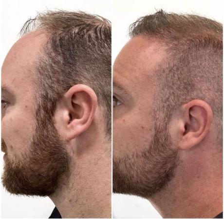 Greffe de cheveux ligne frontale + zone temporale