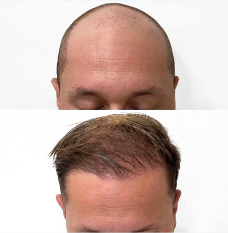 Greffe de cheveux sur une calvitie complète
