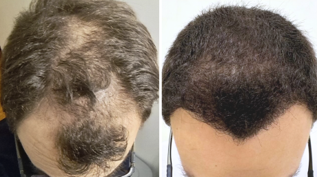 Greffe de cheveux Toulouse Ligne frontale + Tempes + Vertex
