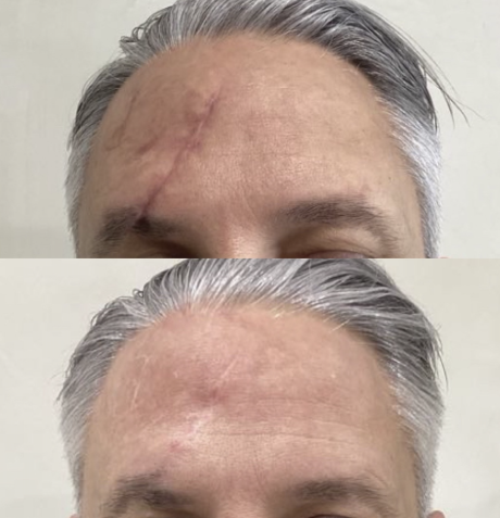 Traitement laser d'une cicatrice sur le visage à Bordeaux