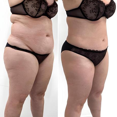 Cryolipolyse ventre femme avec Coolsculpting à Montpellier
