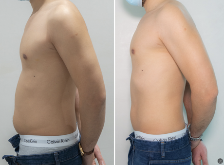 Cryolipolyse ventre homme avec Coolsculpting à Paris