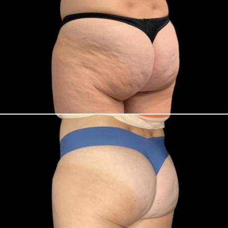 Emtone pour éliminer la cellulite des fesses