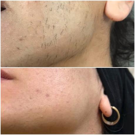 Epilation électrique femme : le visage