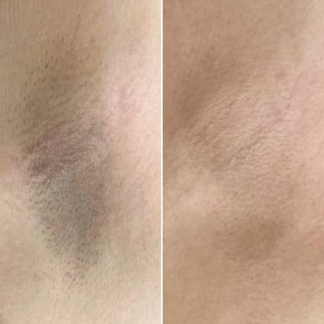 Epilation laser femme : les aisselles