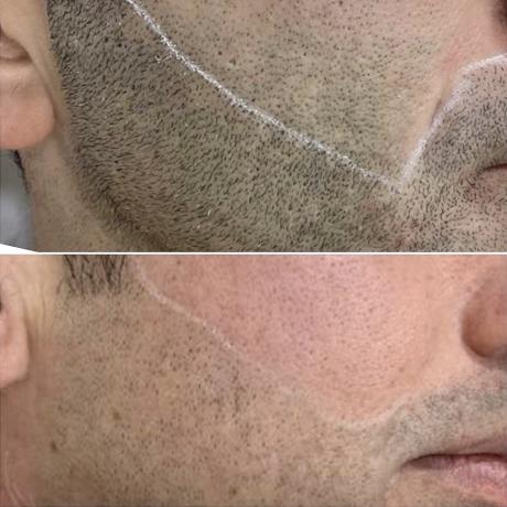 Epilation laser homme : la barbe