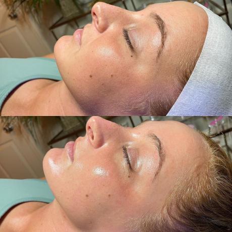 Hydrafacial : Effet glow
