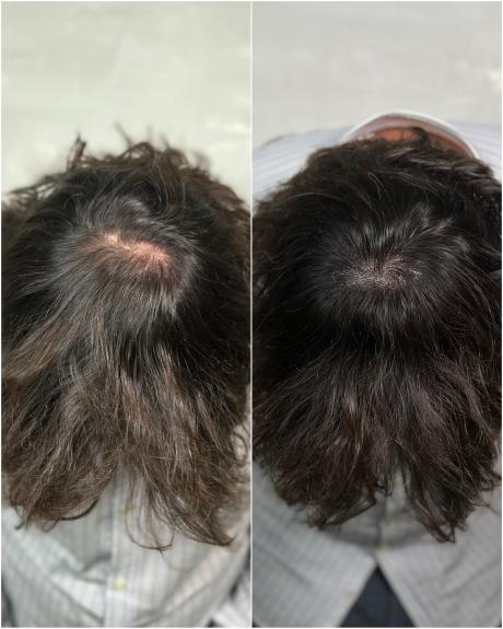 tricopigmentation avant après