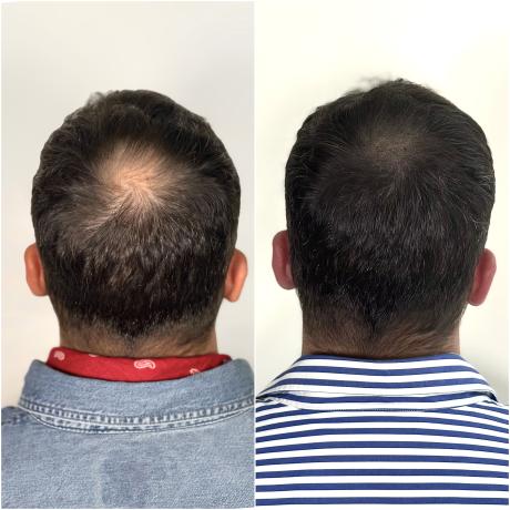 tricopigmentation avant après