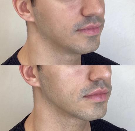 Jawline Contouring - Bordeaux