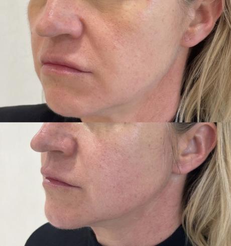 Jawline Contouring - Bordeaux