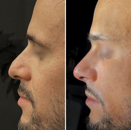 Rhinoplastie médicale - Lyon