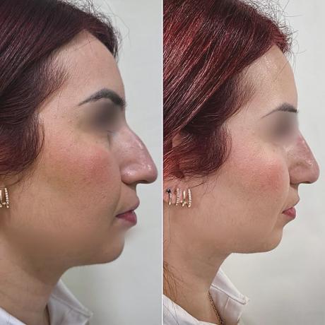 Rhinoplastie médicale - Paris