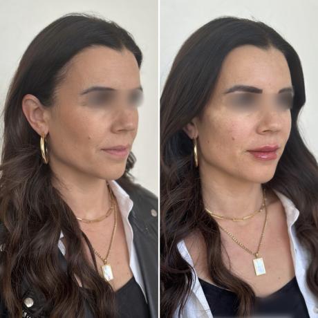 Lifting sans chirurgie - Reims
