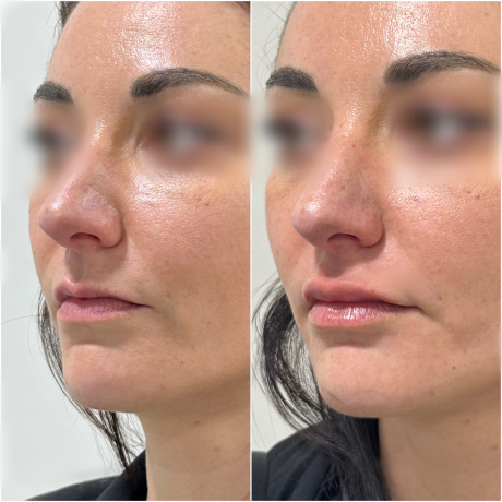 Injection acide hyaluronique lèvres - Clinique des Champs-Elysées Levallois
