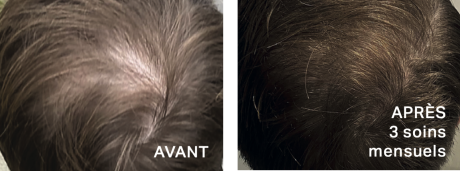 Densification des cheveux sur la zone du vertex