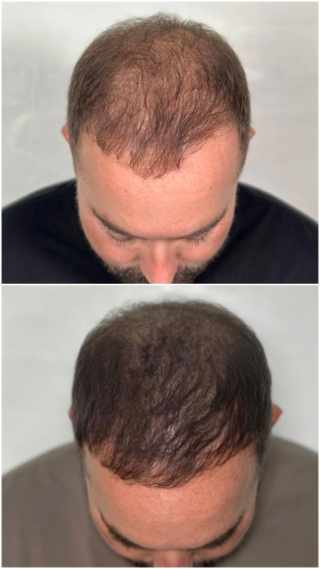 tricopigmentation avant après