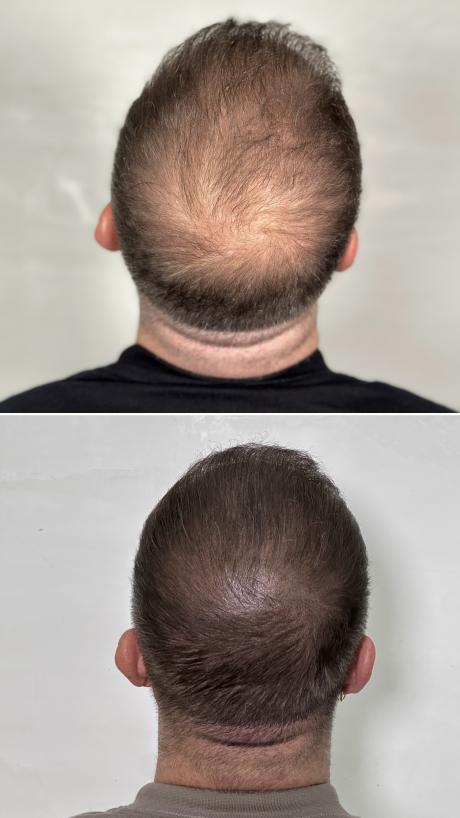 tricopigmentation avant après