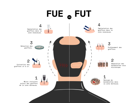 FUE vs FUT : les différences essentielles