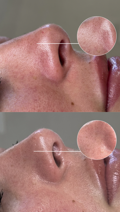 Avant Après Hydrafacial - Points noirs