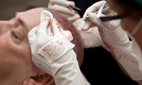 Méthode FUE : implantation des greffons
