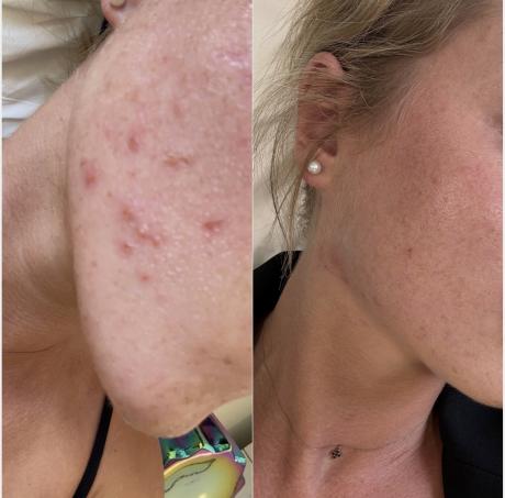 Avant après Clear + Brilliant®