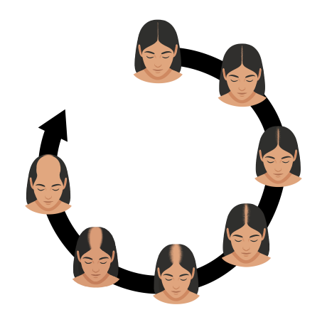 Calvitie femme : Echelle de Ludwig