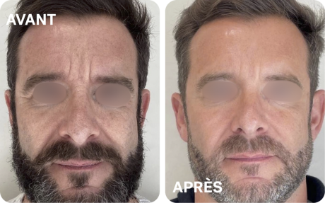 injections-ah-full-face-bordeaux-v2