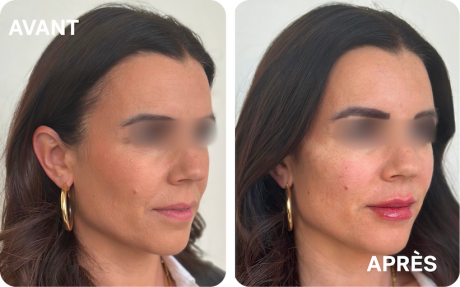 injections-full--face-levres-pommettes-sillons-reims-v2