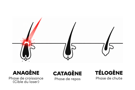 L'épilation laser est-elle efficace en cas de SOPK ?