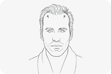 illustration-alopecie-androgenique