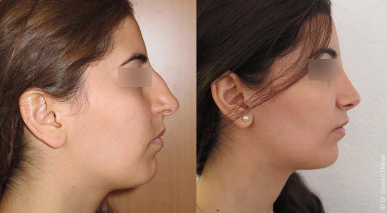 Prix d'une rhinoplastie en france