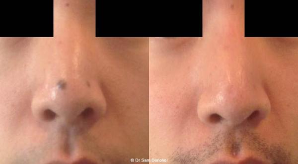Retirer Grain De Beauté Au Laser - Prex