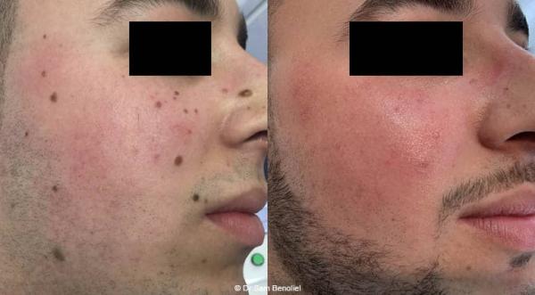 Grains de beauté : Que faire pour les retirer ? | Clinique des Champs ...