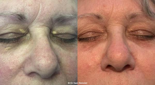 Xanthelasma Comment En Venir A Bout Clinique Des Champs Elysees