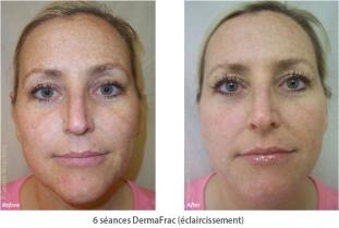 Elimination des taches de rousseur par microneedling | Clinique des Champs-Elysées