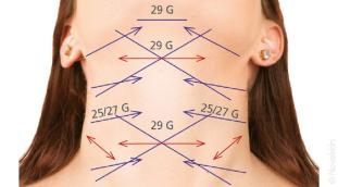 Les différents positionnements des fils tenseurs sur le visage et le corps