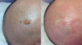 Excroissance de peau : Que faire pour les éliminer ? | Clinique ...