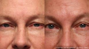 Amélioration du contour inférieur des yeux avec FaceTite