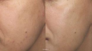 Amélioration de l'acné et de la texture de la peau