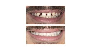 Invisalign Avant / Après