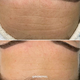 BioRePeelCl3 Visage
