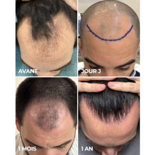 Greffe Cheveux (Golfes Frontaux)