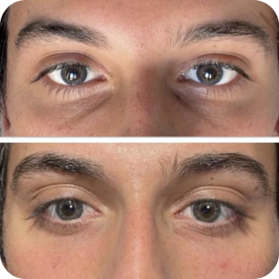 acide-hyaluronique-cernes