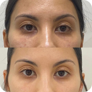 acide-hyaluronique-cernes