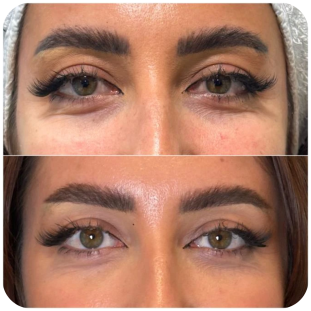 acide-hyaluronique-cernes