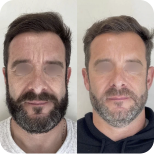 acide-hyaluronique-full-face