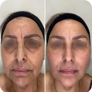 acide-hyaluronique-full-face