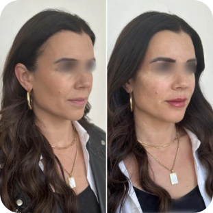 acide-hyaluronique-full-face