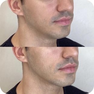 acide-hyaluronique-jawline